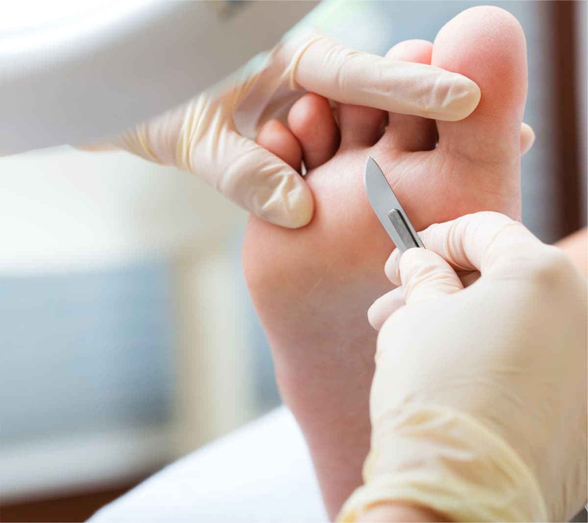 durezas en los pies o callosidades en Santiago de Compostela